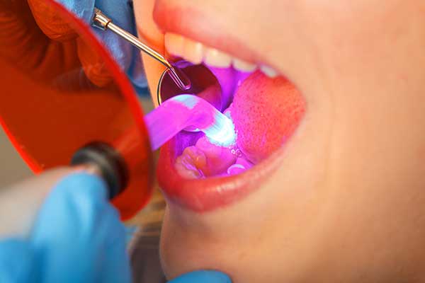 Woman with her mouth open getting a dental bonding