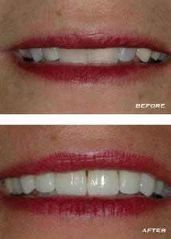 Before and After Teeth Before and After Teeth