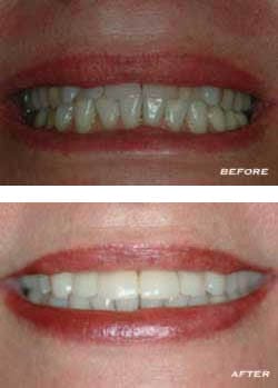 Before and After Teeth Before and After Teeth