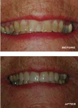 Before and After Teeth Before and After Teeth