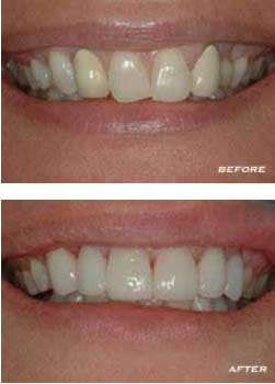 Before and After Teeth Before and After Teeth