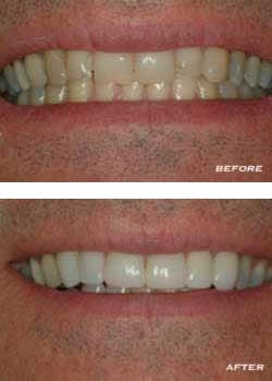 Before and After Teeth Before and After Teeth