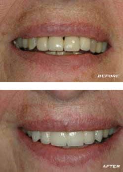 Before and After Teeth Before and After Teeth