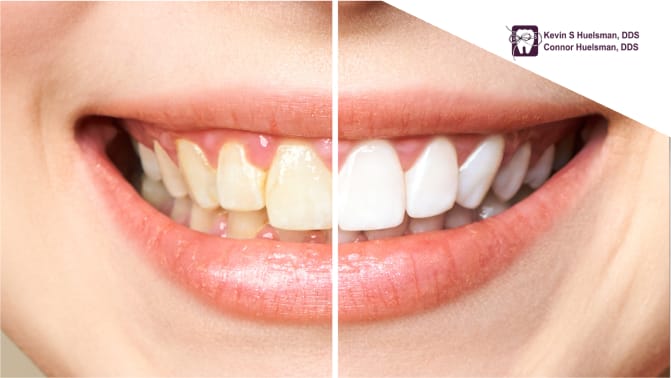 A side-by-side comparison of teeth before and after whitening, highlighting the difference in color and brightness.