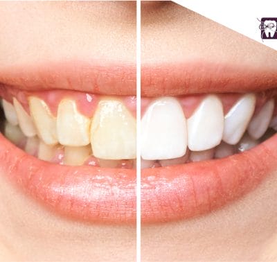 Teeth Whitening